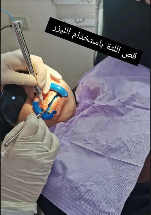 Hollywood Smile Transformation